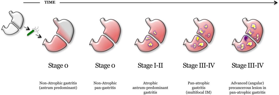 Stages of Gastric Cancer